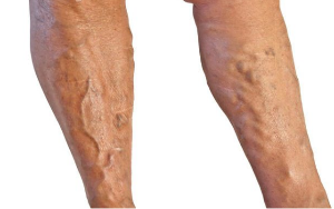 Tratamiento de varices en piernas.
