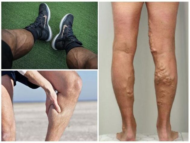 Cómo aparecen las venas varicosas en las piernas de los hombres.