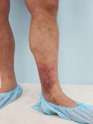 complicaciones de las venas varicosas en los hombres