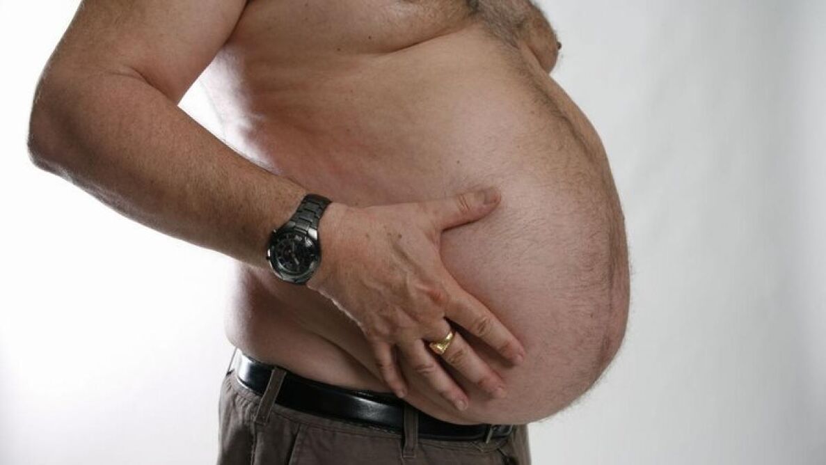 La obesidad como causa del desarrollo de varices. 