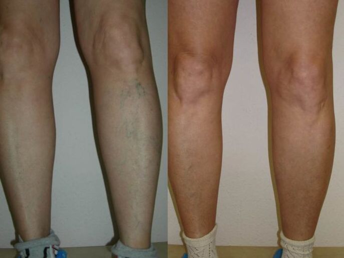 piernas antes y después del tratamiento con láser de varices