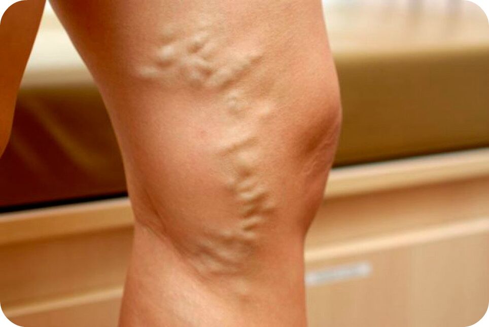 Venas varicosas de las venas