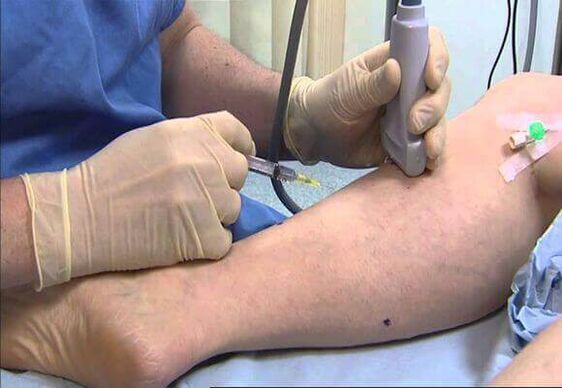 Tratamiento de las venas varicosas