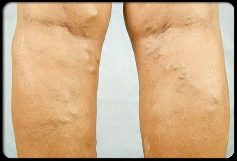 Venas varicosas en las piernas