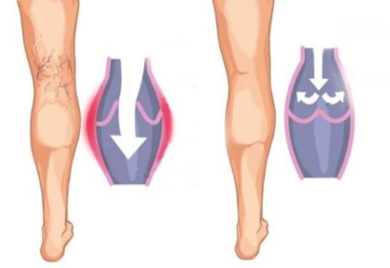 ¿Cómo son las varices